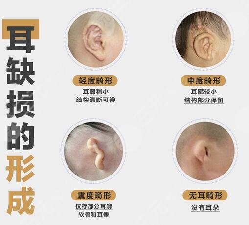 杯狀耳矯正矯正時(shí)機(jī)