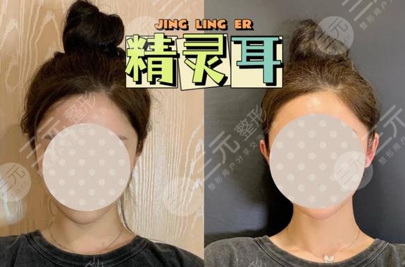 顱耳角在30°-60°之間朵怎么整形