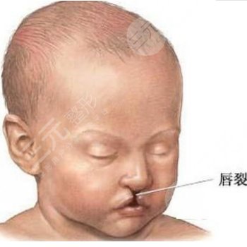 唇腭裂修復(fù)手術(shù)大概需要多少費(fèi)用？什么原因?qū)е铝舜诫窳训漠a(chǎn)生？