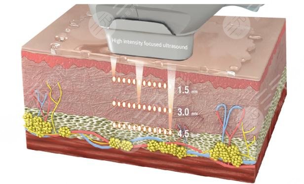 7d聚拉提果維持多久