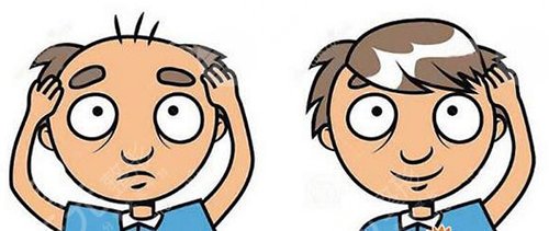 頭發(fā)種植術(shù)靠譜嗎