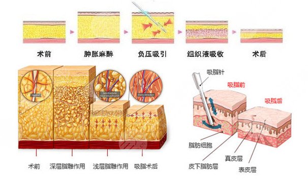 冷凍溶脂減肥靠譜嗎