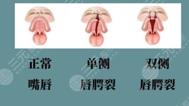 唇腭裂疤痕修復的方法介紹