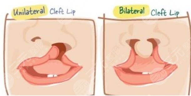 唇腭裂修復(fù)手術(shù)的費(fèi)用是多少呢