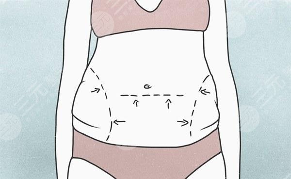 國(guó)內(nèi)吸脂好還是去韓國(guó)吸脂好