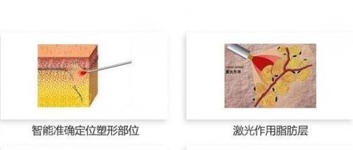 超脂塑溶脂手術(shù)原理是怎樣的