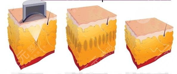 超脂塑溶脂手術(shù)適應(yīng)癥有哪些