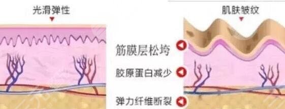 做熱瑪吉的費(fèi)用是多少呢?