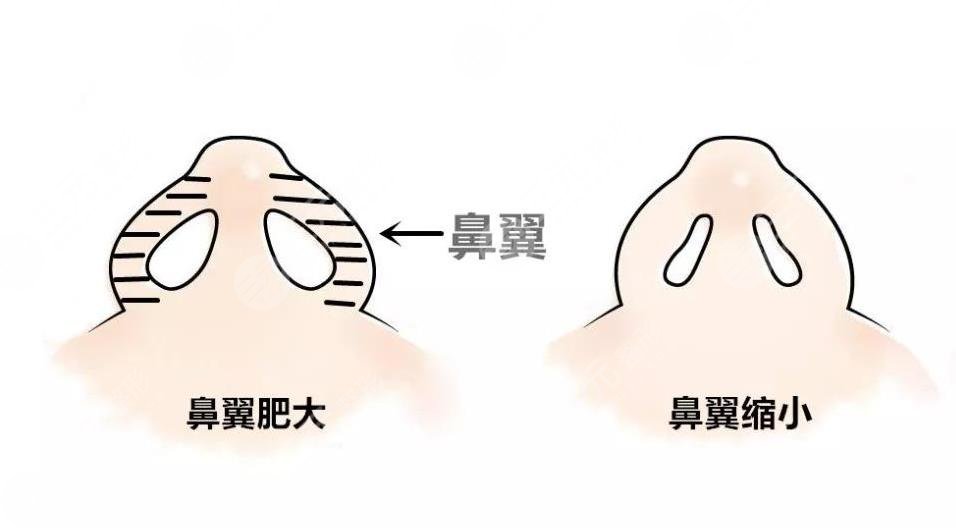 鼻翼太寬怎么整形？鼻翼縮小手術怎么樣？附鼻部整形價格表