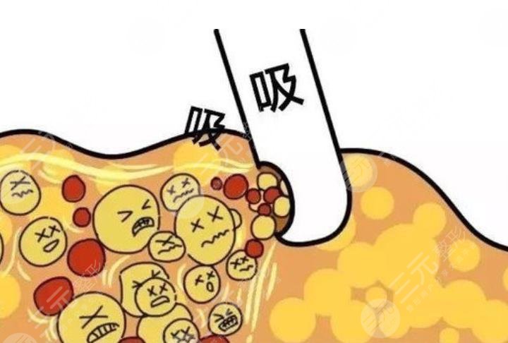 瘦身欄目|超脂塑吸脂有沒(méi)有副作用？來(lái)看看哪些人不適合做！