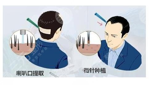 植發(fā)相關問答科普介紹