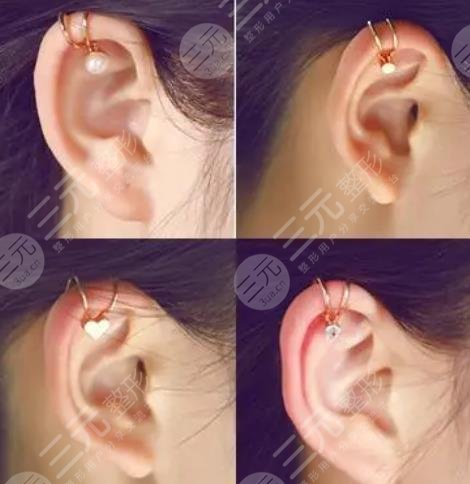 顱耳角在30°-60°之間整形多少錢