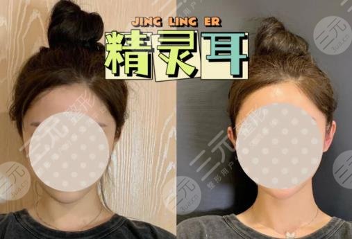 顱耳角在30°-60°之間整形多少錢