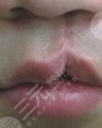 唇腭裂修復(fù)術(shù)前
