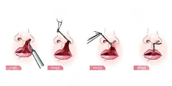 兔唇矯正手術(shù)之后需要怎么去護(hù)理