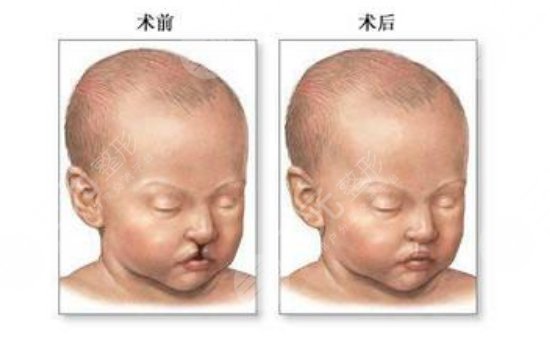 做疤痕修復(fù)手術(shù)注意事項(xiàng)