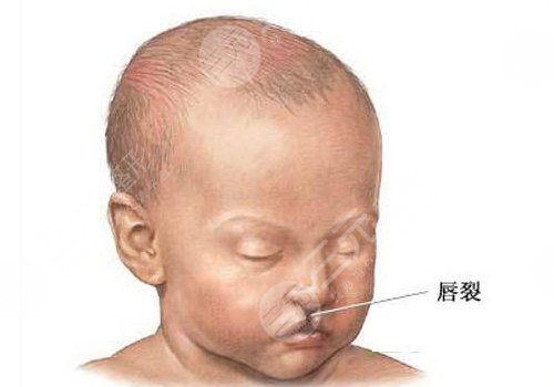 兔唇疤痕修復(fù)的時機是什么時候