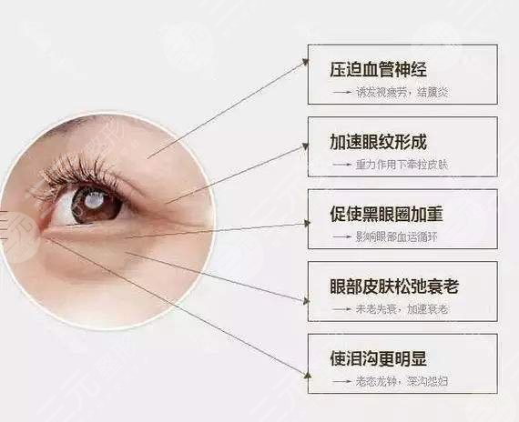 上瞼下垂矯正術(shù)