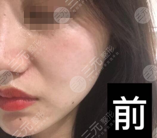 真人體驗(yàn)激光除皺前