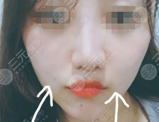 真人體驗(yàn)激光除皺后