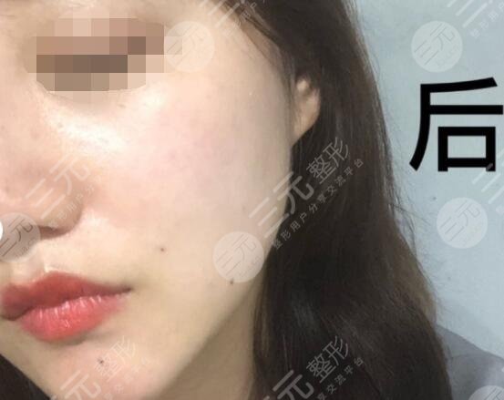 真人體驗(yàn)激光除皺后 果