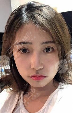 維納斯抗衰儀面部抗衰案例果圖