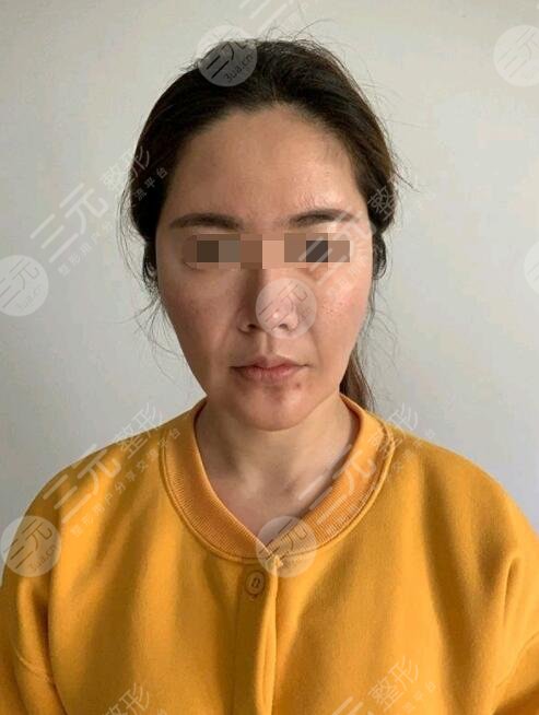 btl射頻緊膚真人案例前