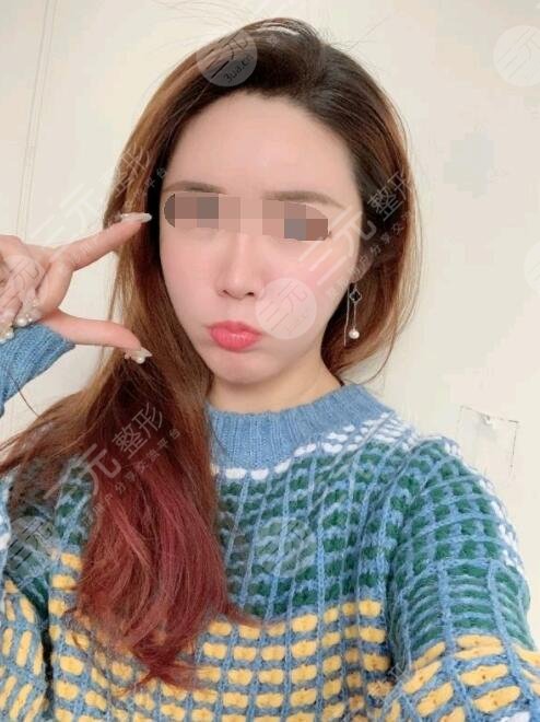 btl射頻緊膚真人案例后一個(gè)月