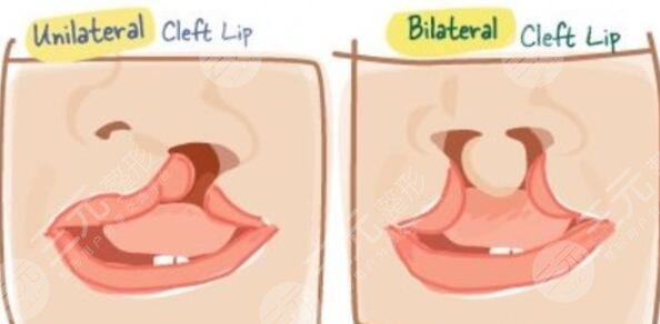 唇腭裂