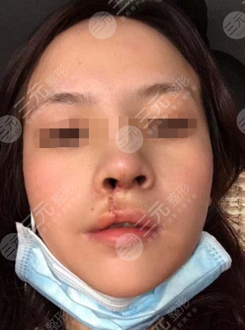 真人做兔唇修復(fù)后一個月