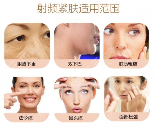 做射頻緊膚的注意事項(xiàng)