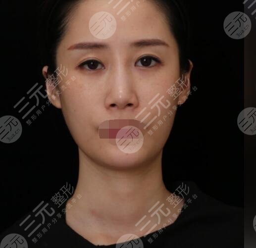 射頻緊膚真人案例術(shù)前