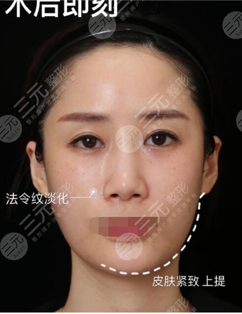 射頻緊膚真人案例術(shù)后