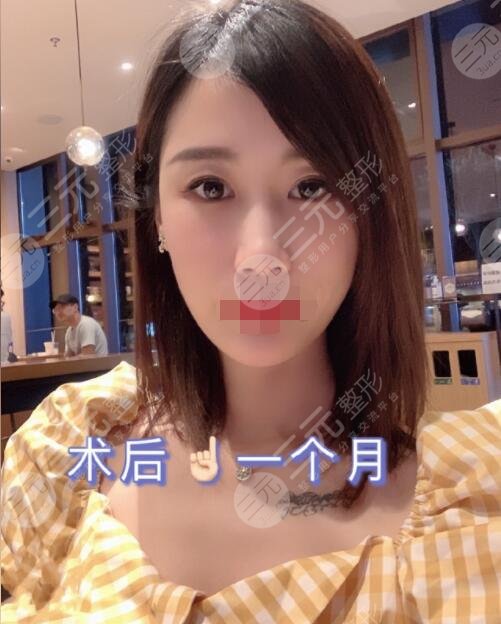 射頻除皺手術(shù)后一個(gè)月