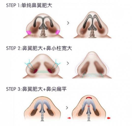 影響鼻翼縮小手術(shù)價格的因素