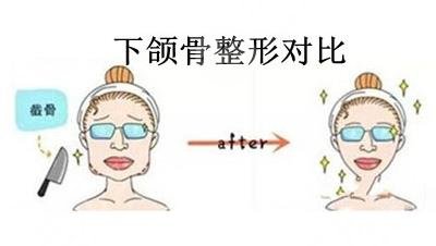 方臉和國(guó)字臉如何改良