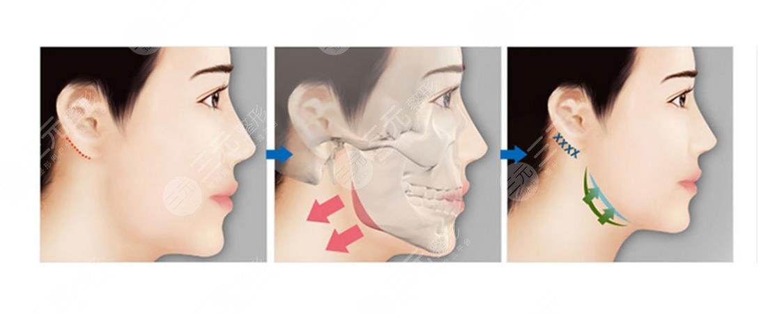 下頜角整形術(shù)后注意事項(xiàng)