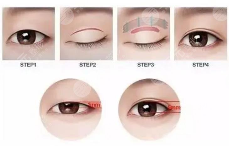 割雙眼皮相關(guān)知識科普