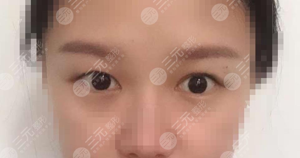 做雙眼皮修復(fù)之前