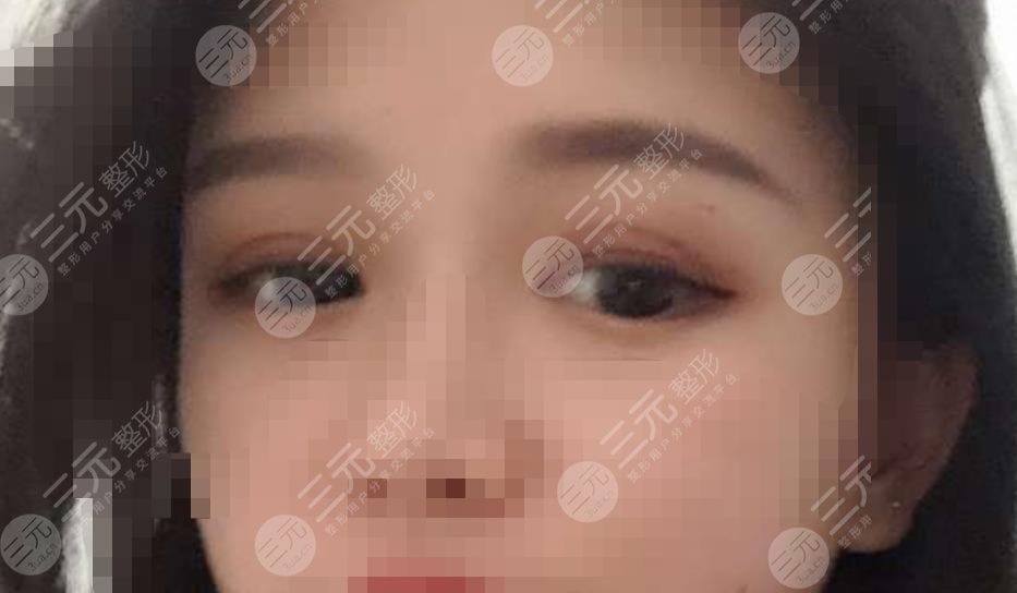 做雙眼皮修復(fù)之后