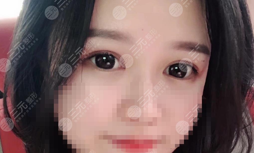 做雙眼皮修復(fù)之后