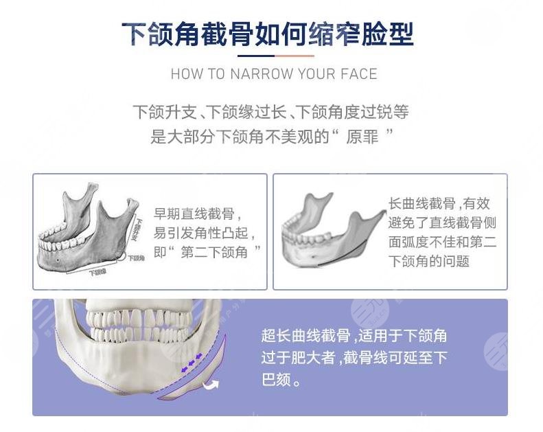 顴骨整形術(shù)原理