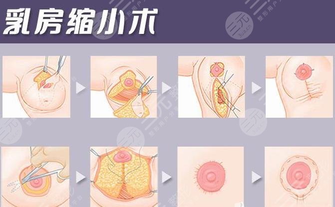 乳房縮小棒棒糖手術(shù)法是什么?
