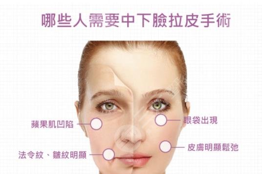 科普|中面部拉皮手術切口在哪兒？費用是多少？一個月消腫是真的嗎？