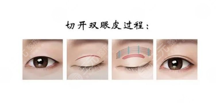 全切雙眼皮
