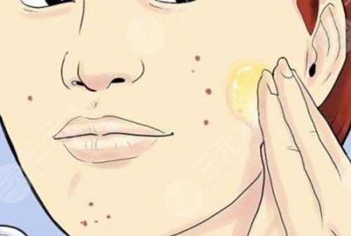 彩光祛痘注意事項(xiàng)