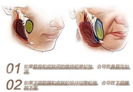 內(nèi)窺鏡除皺術(shù)缺點(diǎn)科普！手術(shù)果到底咋樣？一文解答你的困惑，附價(jià)格~