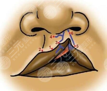 兔唇手術的費用