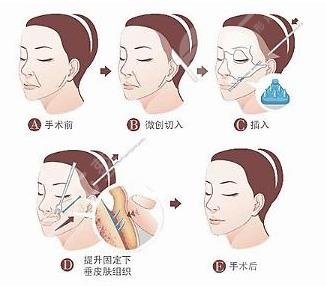 什么叫拉皮手術(shù)?