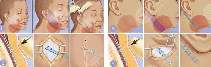 內(nèi)窺鏡拉皮和普通拉皮的區(qū)別在哪里?